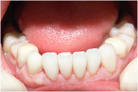 審美歯科症例09