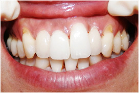 審美歯科症例10