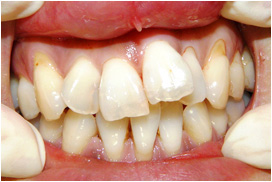 審美歯科症例10