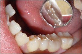 審美歯科症例11