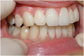 審美歯科症例12