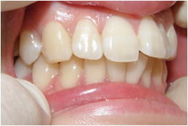 審美歯科症例12