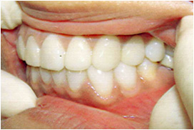 審美歯科症例13