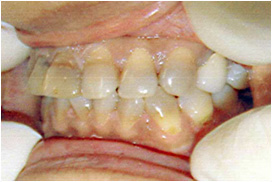 審美歯科症例13